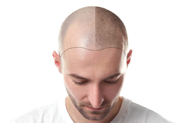 scalp-micropigmentation-for-hair-loss